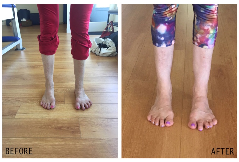 ballet feet before and after