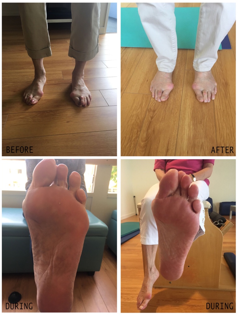 ballet feet before and after